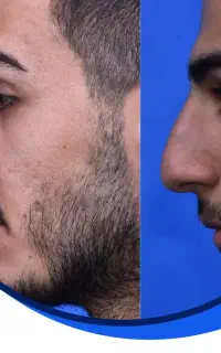 تخفیف ویژه عمل بینی تا عید غدیر