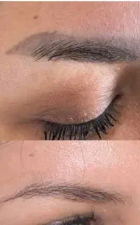 اف لیزر پیکوشور ریموو تتو