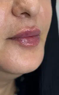 بوتاکس‌/فیلر‌/آمپول لاغری‌/PRP توسط پزشک زیبایی