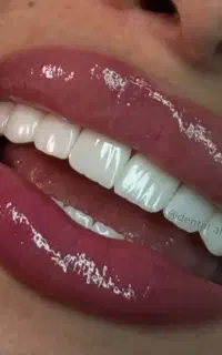 دندانپزشکی کامپوزیت عصب کشی در شهرری ۴۰٪تخفیف