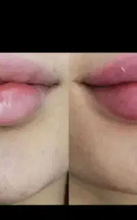 پوست منافظ چروک کبودی تیرگی لکه شفاف