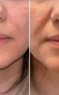 هایفوتراپی صورت و اندام