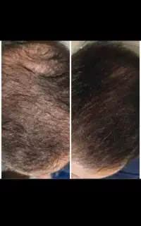 جشنواره تخفیفی انجام مزو وپی ارپی واگزوزوم تراپی