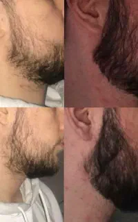 رفع کمپشتی ریش به صورت تخصصی