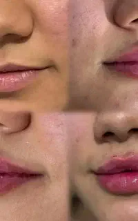 تزریق ژل،فیلر،بوتاکس،فول فیس،کانتورینگ