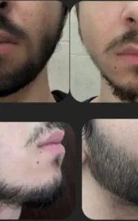 رویش مو و ابرو دوز بالا