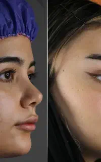 لیفت صورت فیلر فول فیس مادلینگ فیلر بینی زاویه فک