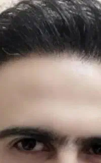 کاشت مو فقط ۴میلیون