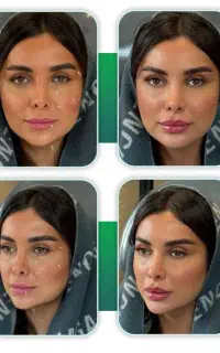 جشنواره بوتاکس پی ار پی مزوتراپی