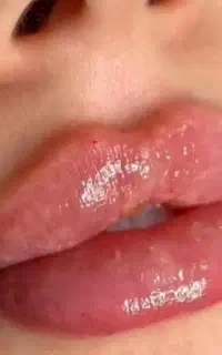 تزریق ژل و بوتاکس