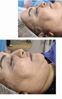 ژل بوتاکس جوانساز ساکشن غبغب توسط پزشک