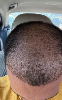کاشت مو و ابرو کلینیک تخصصی تبریز