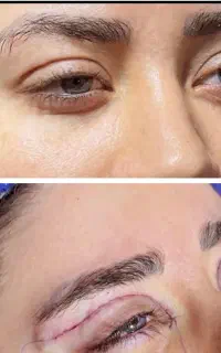 حرفه ای ترین تکنیک امریکایی بلفارو