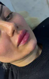 اف تزریق ژل بوتاکس با ضمانت اورجینال بودن