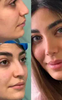 جشنواره ژل،بوتاکس،هایفو،بلفارو،انواع جراحی زیبایی
