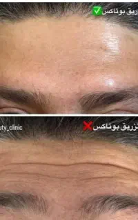 درمان ریزش مو و چروک با تخفیف
