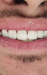 کامپوزیت زیبایی دندانپزشکی  ارتودنسی