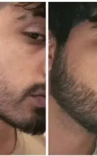 پرپشتی نواحی خالی سر و صورت