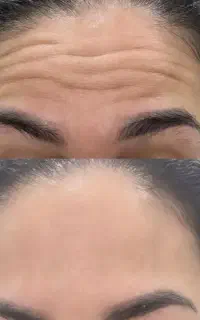 آفر ویژه روز پزشک فیلر و بوتاکس ومیکروبیدلینگ ابرو
