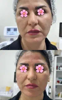 هایفو تراپی حرفه ای با دستگاه الترا فورمر هفت بعدی