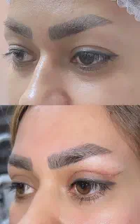 بلفاروپلاستی چشم گربه ای ارومیه(شرایط چکی)