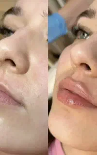 تزریق فیلر و بوتاکس رایگان ( برای مدل )