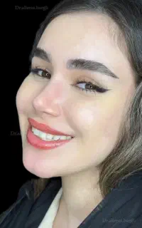 ۵۰ درصد تخفیف عمل جراحی بینی بدون تامپون با پیزو
