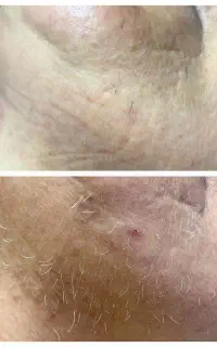 الکترولیز(رفع دائمی موهای سفید،بور،هورمونی)
