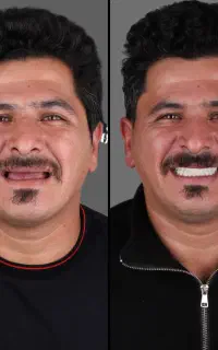 دندانپزشکی/روکش/ارتودنسی/کاشت‌دندان/محدود