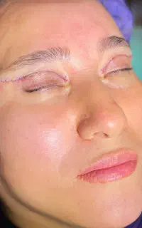 عمل پلک با تعرفه دولتی /بخیه لیزری