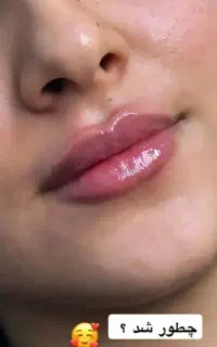 جشنواره عیدانه تزریق ژل و بوتاکس و لاغری در کلینیک