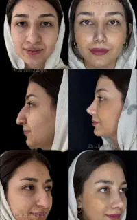 عمل بینی با هزینه ی پارسال(فقط تاپایان اردیبهشت)