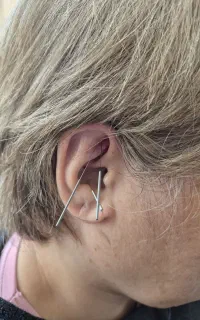 طب سوزنی گوش و کلاسیک (دکتر علی بابایی)