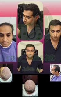 کاشت مو با ضمانت نامه
