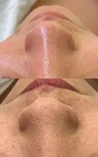 آموزش فیشیال وپاکسازی