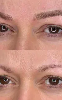فیبروز و میکروبلیدینگ تخصصی.زیبایی نچرال