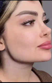 جشنواره تزریق تخصصی ژل لب و فرم دهی صورت 750 تومان
