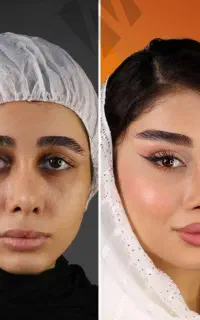 آف ۵۰٪ پکیج ابرو FOX EYE پزشک پوست مو بینی زیبایی