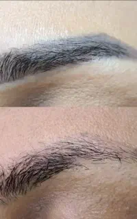 رفع تاتو و خالکوبی و تیرگی با لیزر