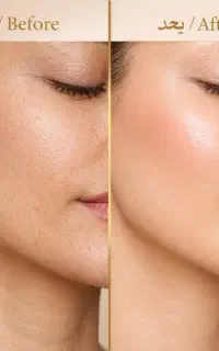 لیزر مو در۴جلسه خانم و آقا،لیزر سفید کننده،لیزرتتو