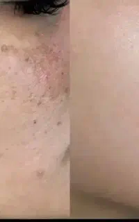 جشنواره تخفیف خال و لک برداری