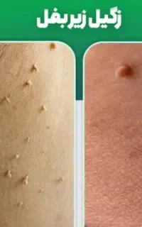 فروش مواد زگیل تناسلی گردن و زیر بغل تضمینی