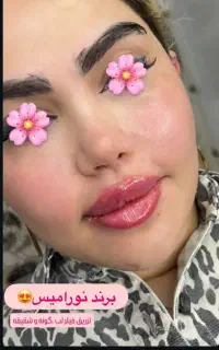 تزریق ژل صورت بوتاکس صورت تخفیف ۴۰ درصدی