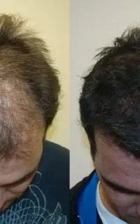 قبل از کاشت انجامش بده