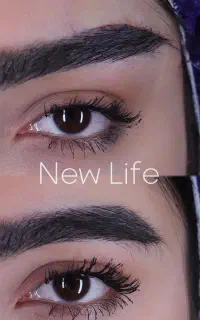 دایرکت ابرو جایگزین لیفت شقیقه