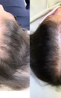 شروع رویای پرپشتی