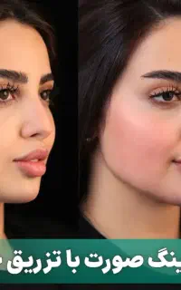 تخفیف ویژه تزریق چربی صورت