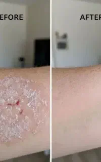 یک برای همیشه ریشه‌ای پسوریازیس رو درمان کن