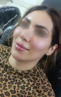 جشنواره تخفیف محرم میکروبلیدینگ فیلر ژل