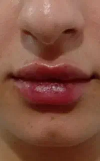 بوتاکس و فیلر (ژل) با ۲۰٪ و ۲۵٪ تخفیف